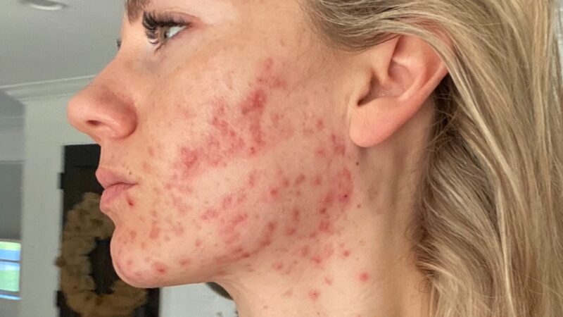 Cystic Acne